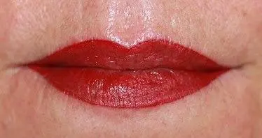 Kräftige Lippen mit Lippenvergrößerung Nachher
