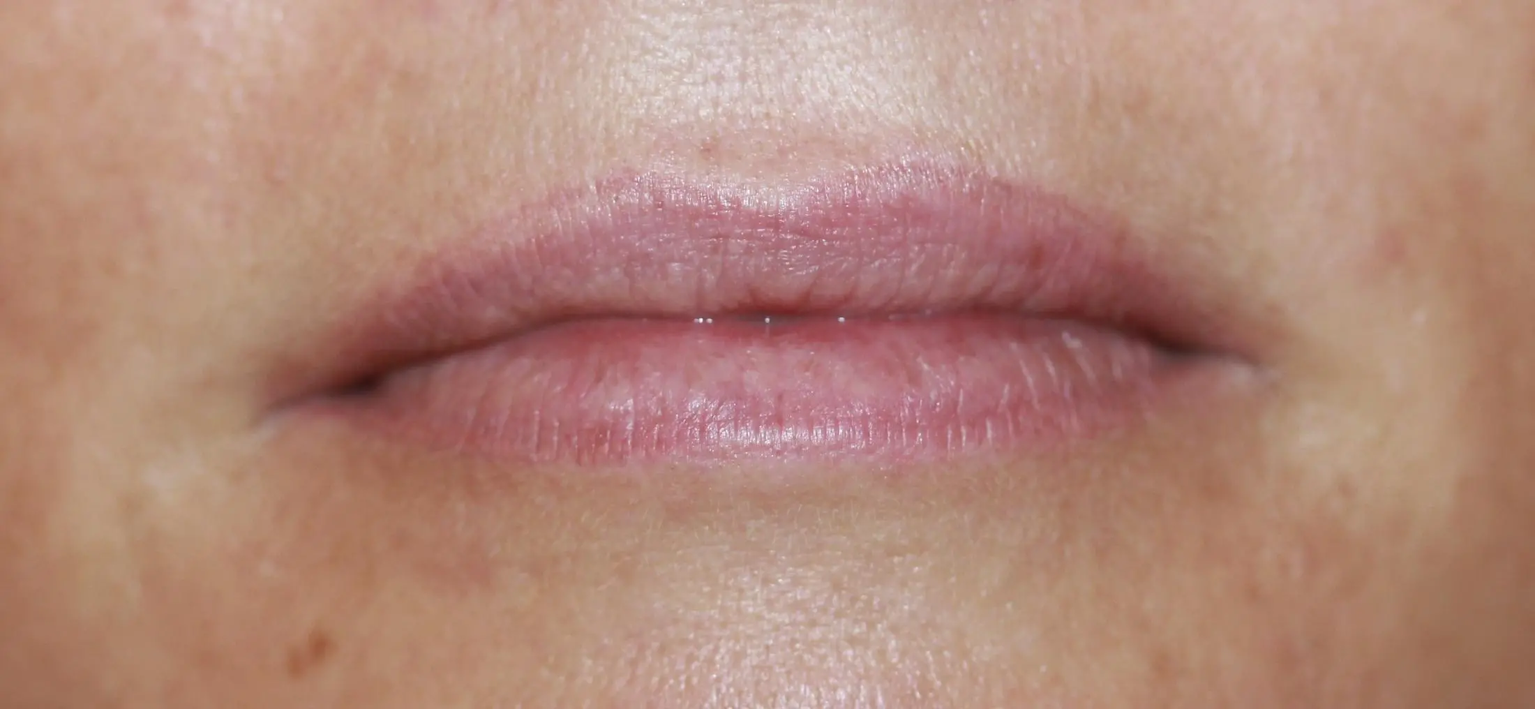 Natürliche Lippenvergrößerung