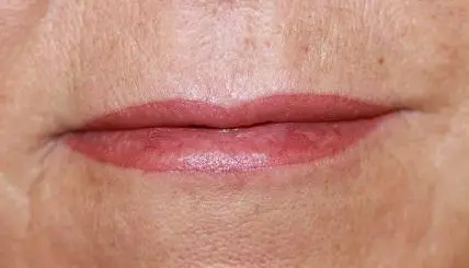 Lippen Nachher